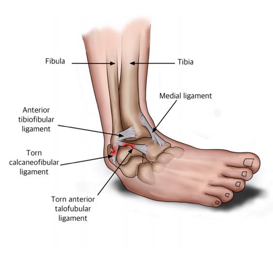 Diagram of the ligaments affected in an Ankle Sprain, also known as a sprained ankle