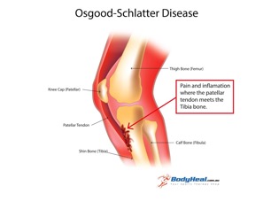 Osgood Schlatter Disease causes pain in the front of the knee, around the tibial tubercle.