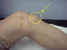Osgood Schlatter Disease causes pain in the front of the knee, around the tibial tubercle.