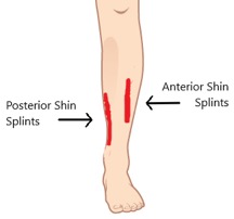 There are two types of shin splints: posterior and anterior