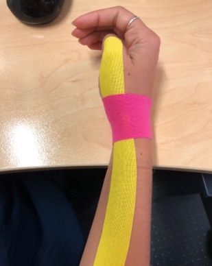The pain experienced with De Quervain Tenosynovitis can be helped by limiting movement in the thumb and wrist through taping. 
