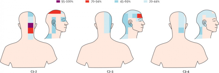 cervicogenic headache: causes, symptoms, diagnosis and treatment - Ryde ...